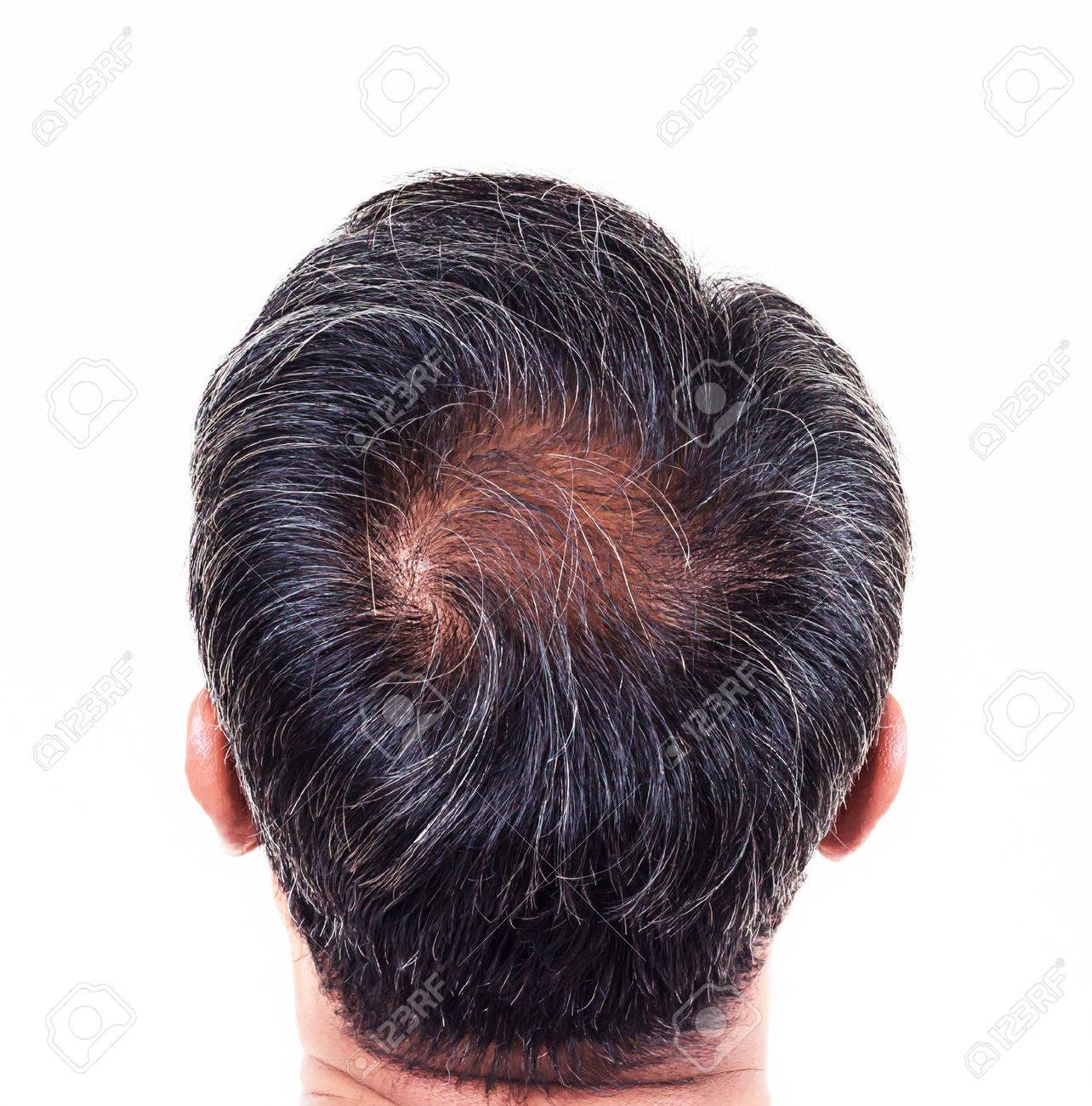 hair loss and grey hair, Male head with hair loss symptoms back side. - 43671824 hair loss and grey hair, Male head with hair loss symptoms back side. - 43671824