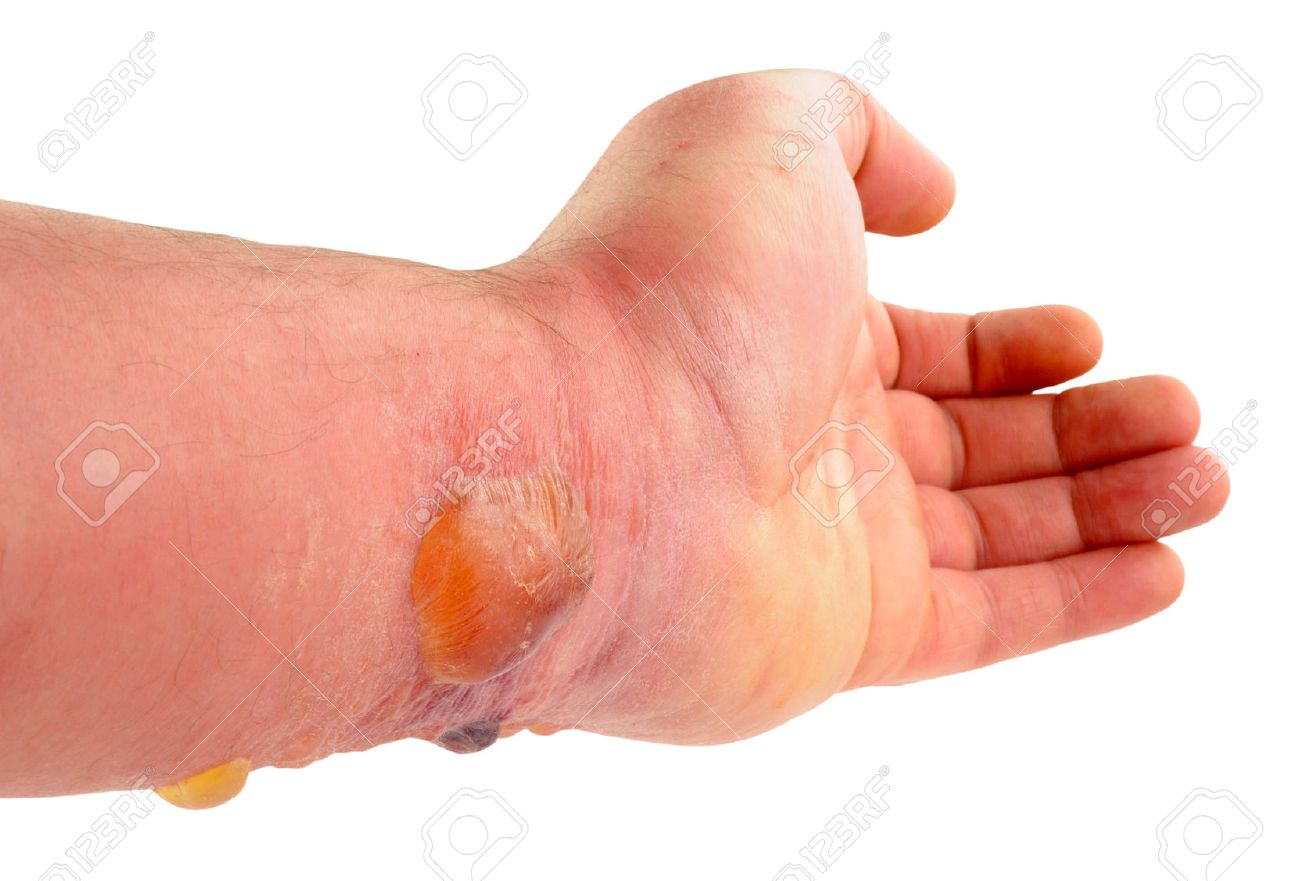 Brazo Con Las Burbujas Causadas Por Una Causa Reaccion Alergica Grave Por Un Tabano Picadura De Un Insecto Aislado En Un Fondo Blanco Fotos Retratos Imagenes Y Fotografia De Archivo Libres De