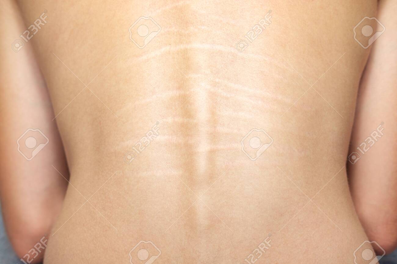 Close Up View Of The Back With stretch Marks On The Skin. The