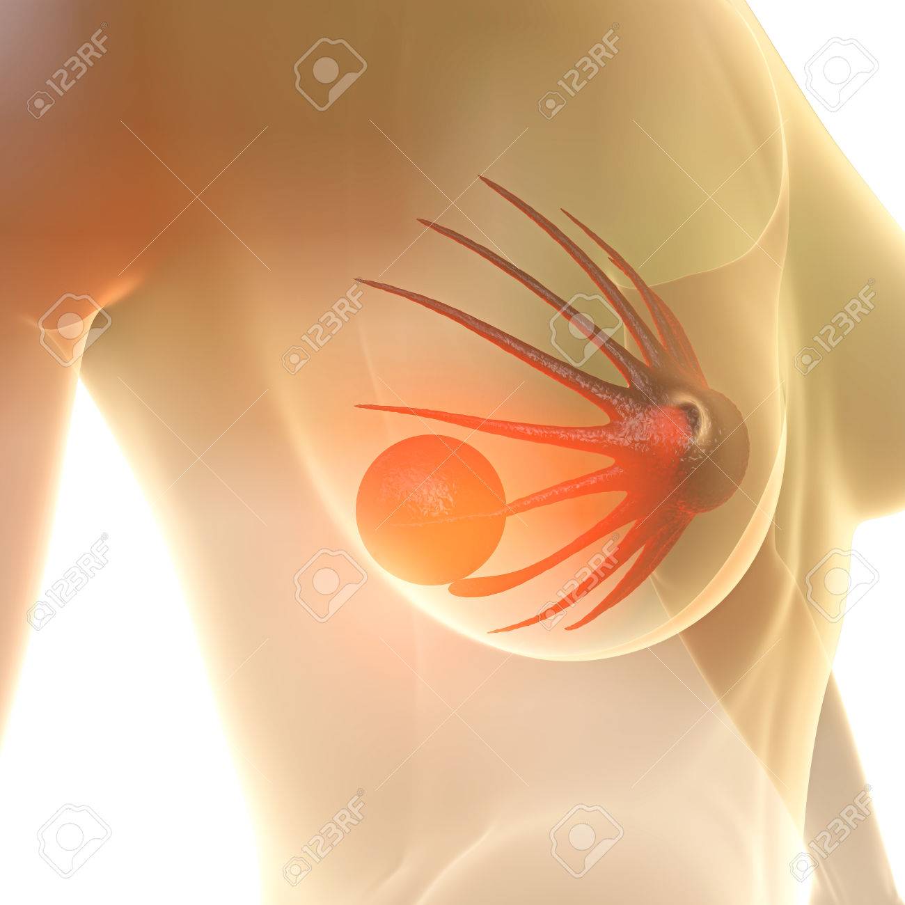 http://previews.123rf.com/images/pictur/pictur1503/pictur150300246/37732089-Breast-Lump-3d-rendered-illstration-Stock-Photo.jpg