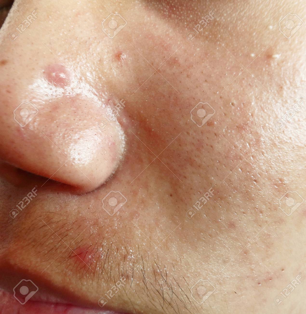 oily skin acne scars