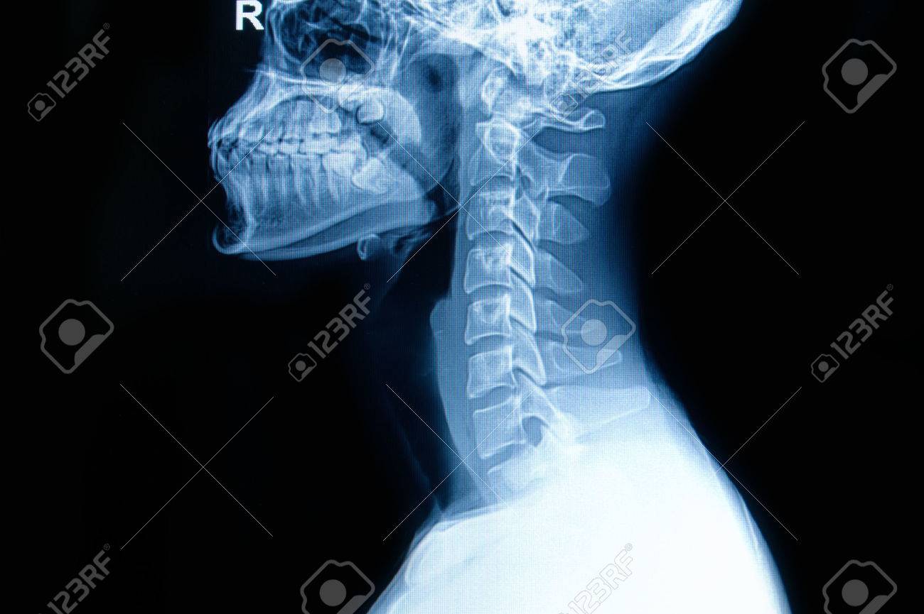 x ray of human cervical spine stock photo picture and royalty free