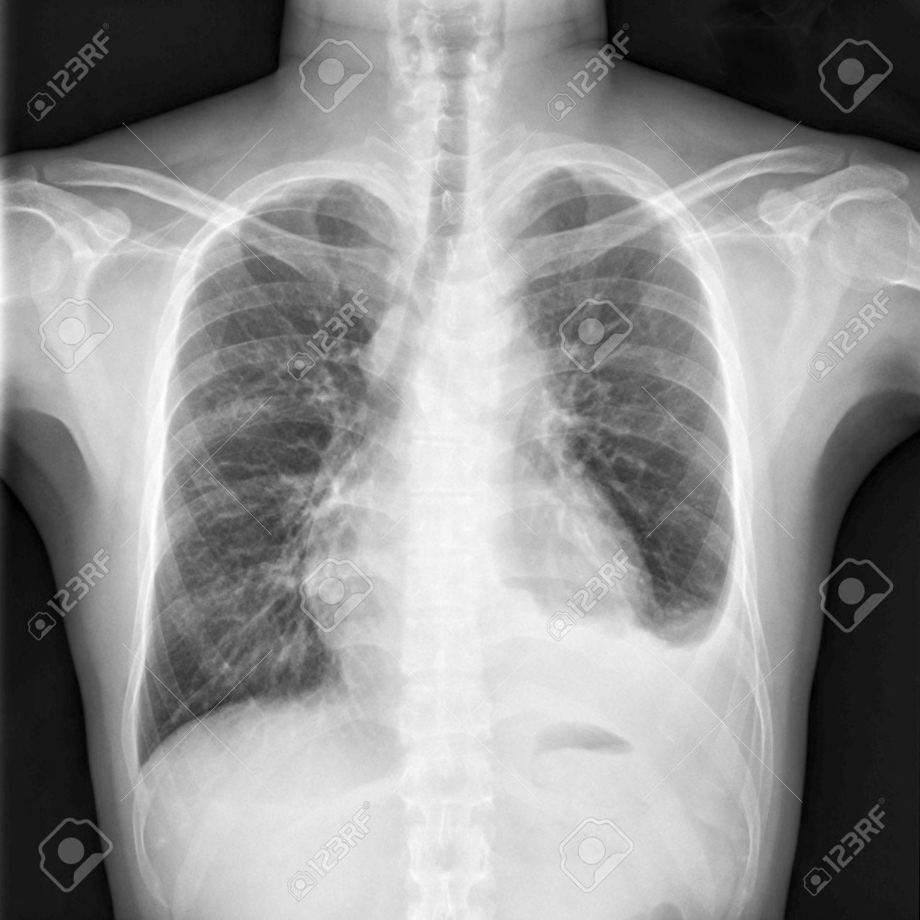 Derrame pleural en ingles