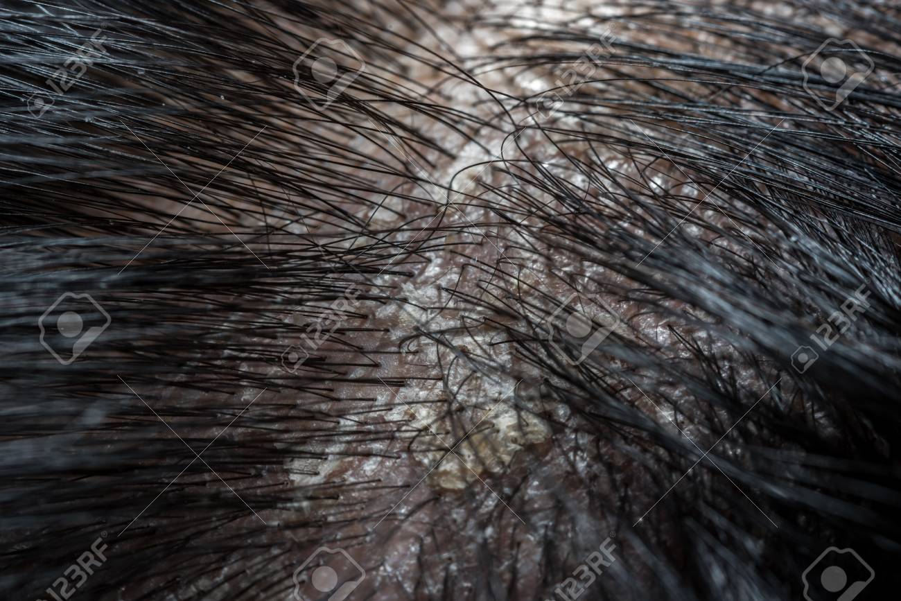Macro Of Hair Scalp Asian Human With Black Hairline Have A Problem With Dandruff And Scaly From Psoriasis Because Hormonal, Dirty And Stress Stock Photo, Picture And Royalty Free Image. Image 108636322. Macro Of Hair Scalp Asian Human With Black Hairline Have A Problem With Dandruff And Scaly From Psoriasis Because Hormonal, Dirty And Stress Stock Photo, Picture And Royalty Free Image. Image 108636322.