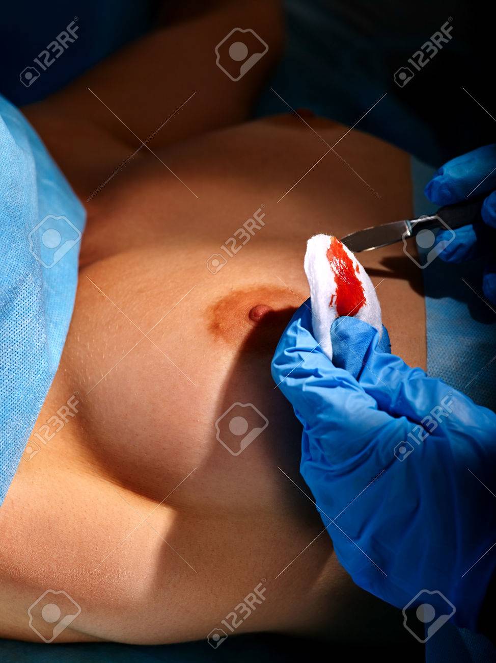 breast surgery operation Sherry hustler club