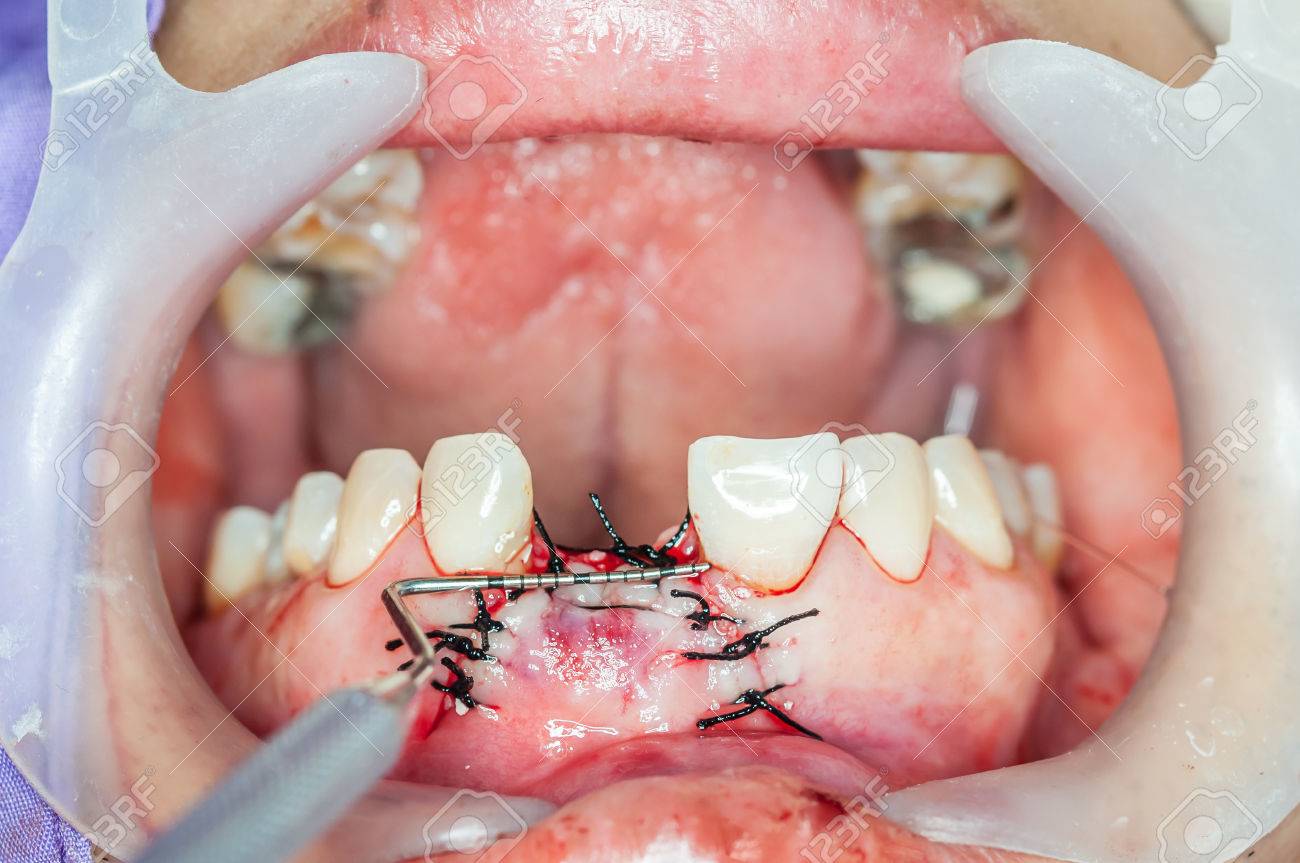 Implantes De Cirugía Dental En Paciente Real Fotos, Retratos, Imágenes Y  Fotografía De Archivo Libres De Derecho. Image 40782708.