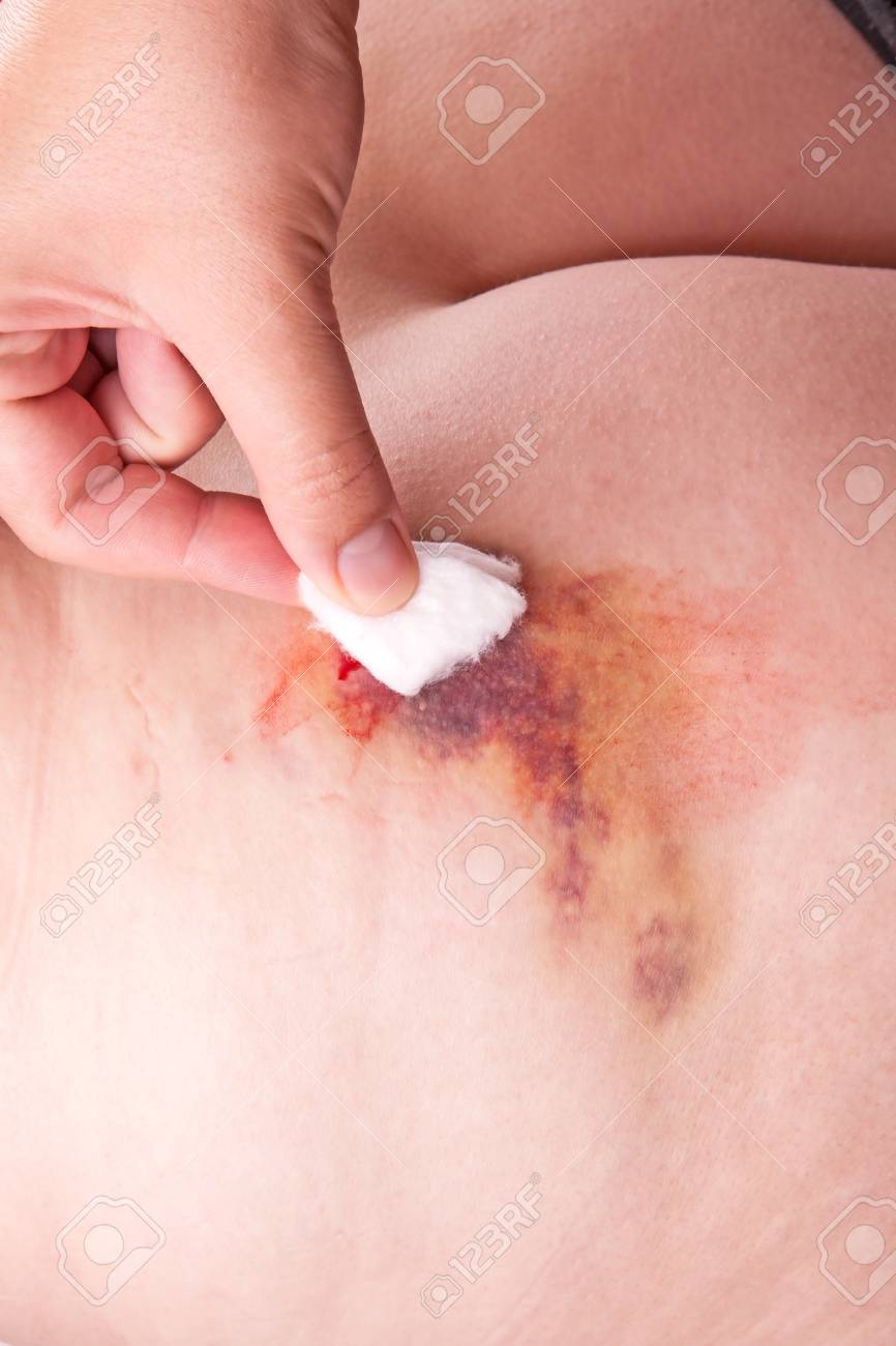 Grand Hématome De Linjection Dans La Partie Supérieure De La Fesse Banque  DImages et Photos Libres De Droits. Image 30913158