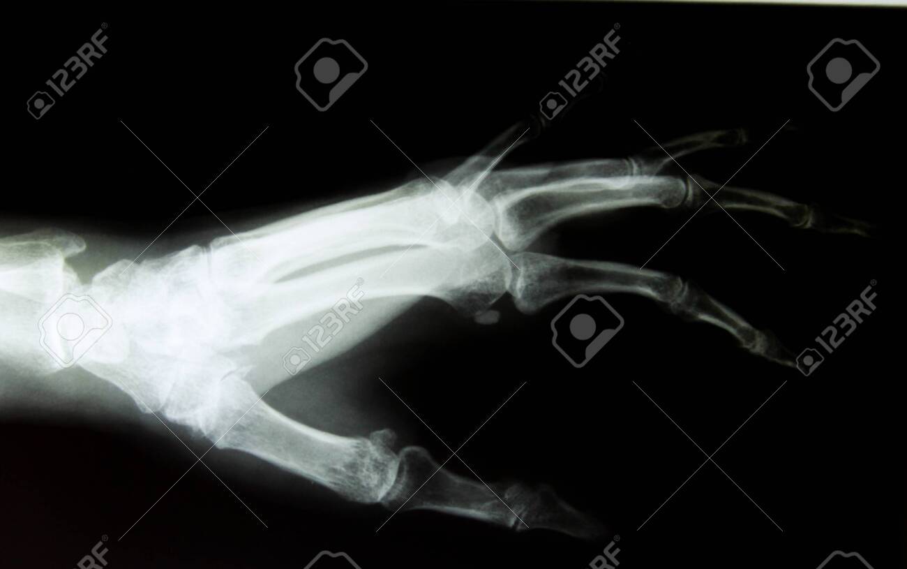 X-ray Image Of Healthy Normal Human Hand Stock Photo, Picture And Royalty  Free Image. Image 136068369.