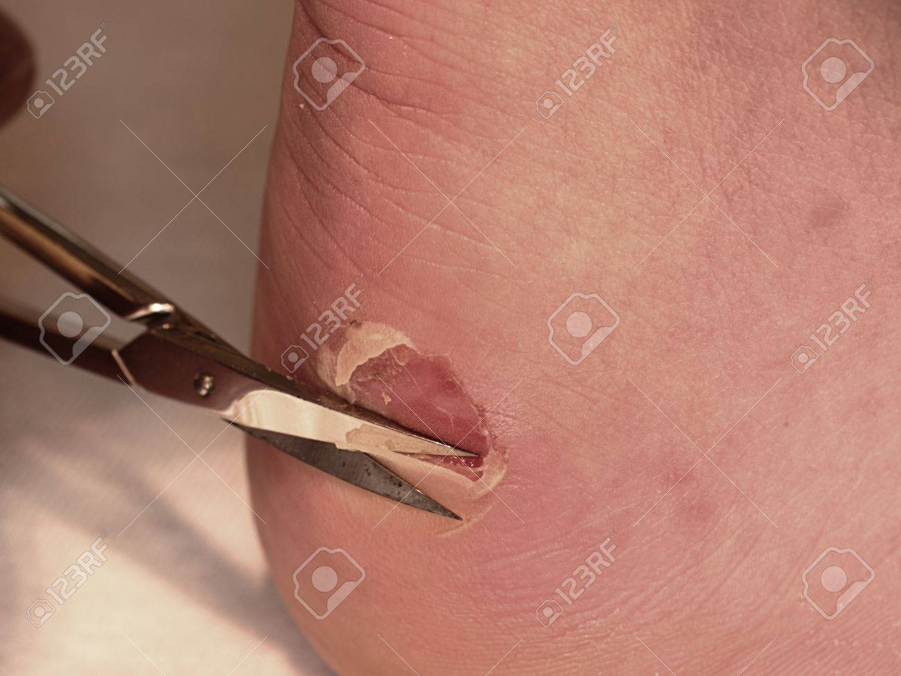 はさみは かかとにひび割れ血水疱で乾燥肌をカットしました 破れた皮膚 血 接液部と非常に痛い場所は皮膚のトレスに巻き の写真素材 画像素材 Image