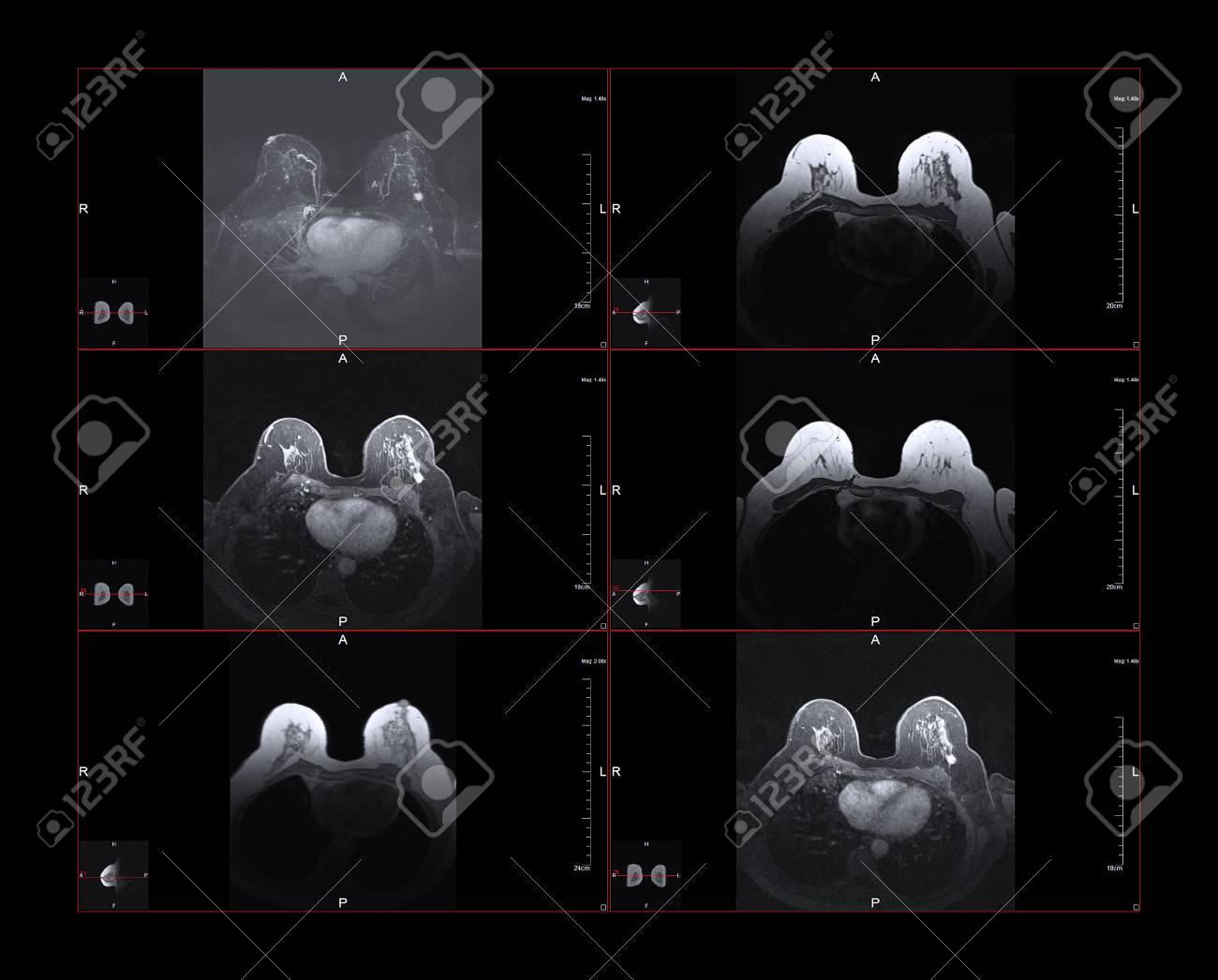 Breast magnetic resonance image, or MRI. The bright white dot in the larger images is Stage One cancer. The small images show the position within the body. - 89930854 Breast magnetic resonance image, or MRI. The bright white dot in the larger images is Stage One cancer. The small images show the position within the body. - 89930854