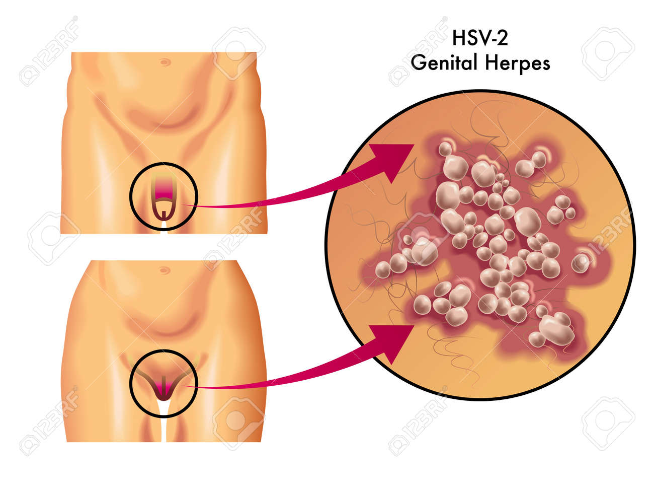 Herpes simplex - Wikipedia Herpes simplex - Wikipedia