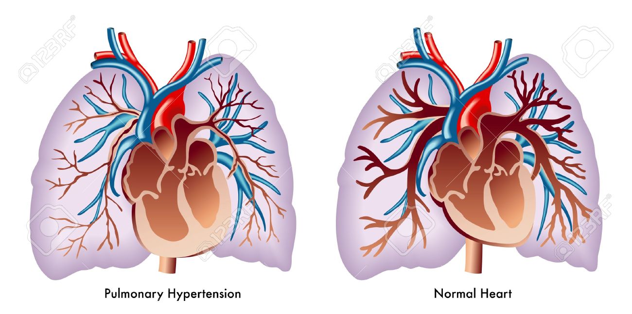 Hipertensión pulmonar en inglés