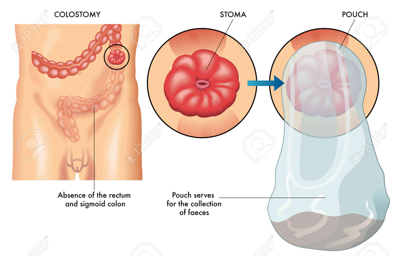 Колостома после операции прямой кишки. Колостома калоприемник. Как выводят прямой кишки. Операция кишечника колостомия. Стома операция толстой кишки.