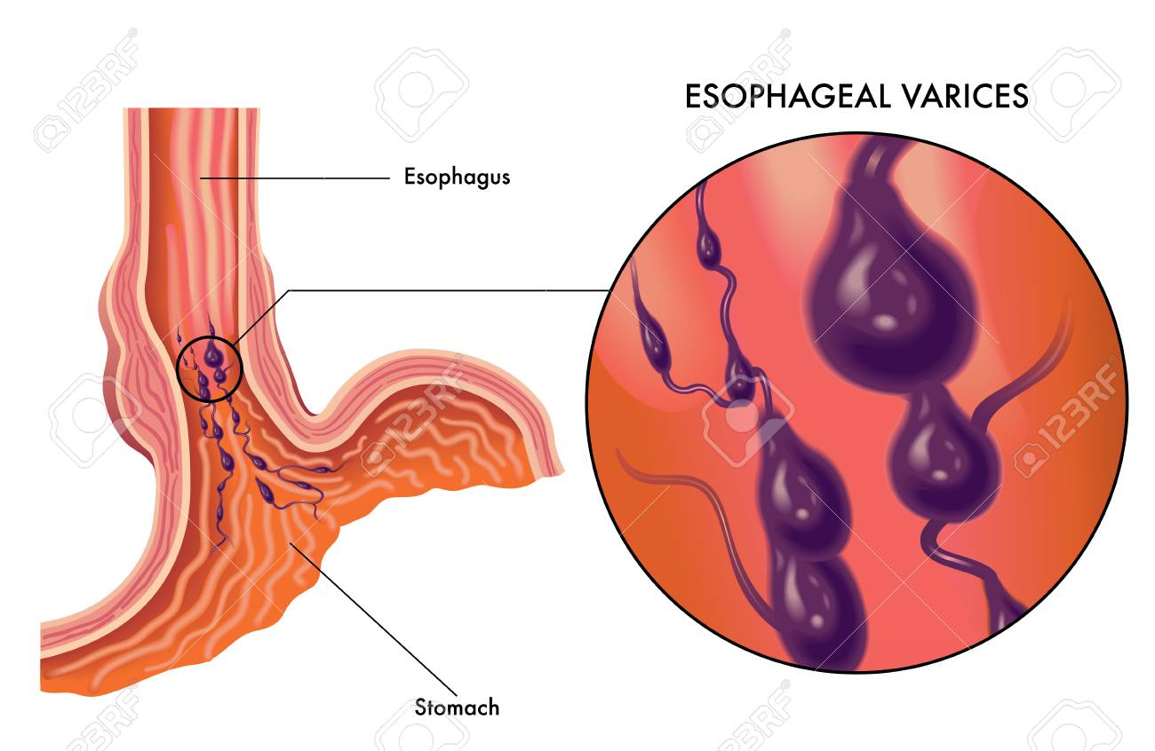 Discussion on this topic: How to Deal With Esophageal Varices, how-to-deal-with-esophageal-varices/ Discussion on this topic: How to Deal With Esophageal Varices, how-to-deal-with-esophageal-varices/