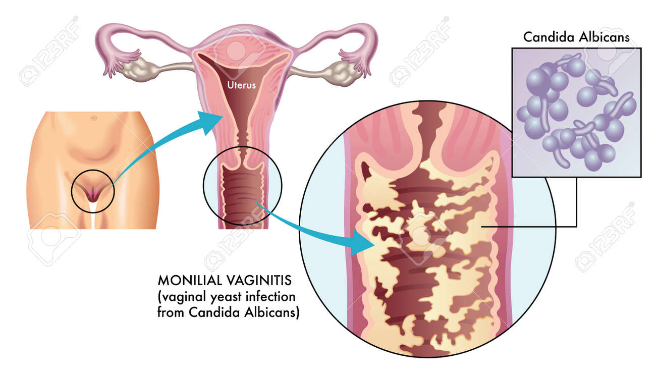 medical illustration of Monilial vaginitis, a vaginal yeast infection caused most commonly by the human fungal Candida albicans - 118489830 medical illustration of Monilial vaginitis, a vaginal yeast infection caused most commonly by the human fungal Candida albicans - 118489830