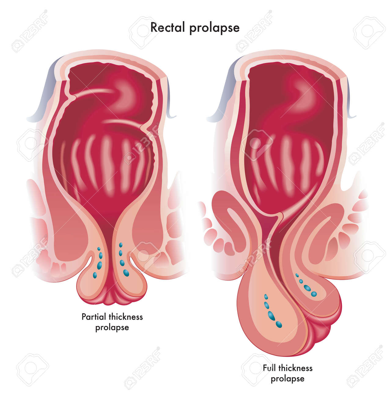 Medical illustration showing two types of rectal prolapse, a partial thickness prolapse, and a full thickness prolapsed. - 151503904 Medical illustration showing two types of rectal prolapse, a partial thickness prolapse, and a full thickness prolapsed. - 151503904