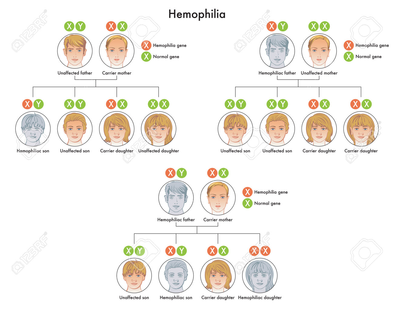 Diagram shows that healthy carrier children or with hemophilia are the consequence of a genetic alteration of the X chromosome transmitted to them by their parents. - 160754731 Diagram shows that healthy carrier children or with hemophilia are the consequence of a genetic alteration of the X chromosome transmitted to them by their parents. - 160754731