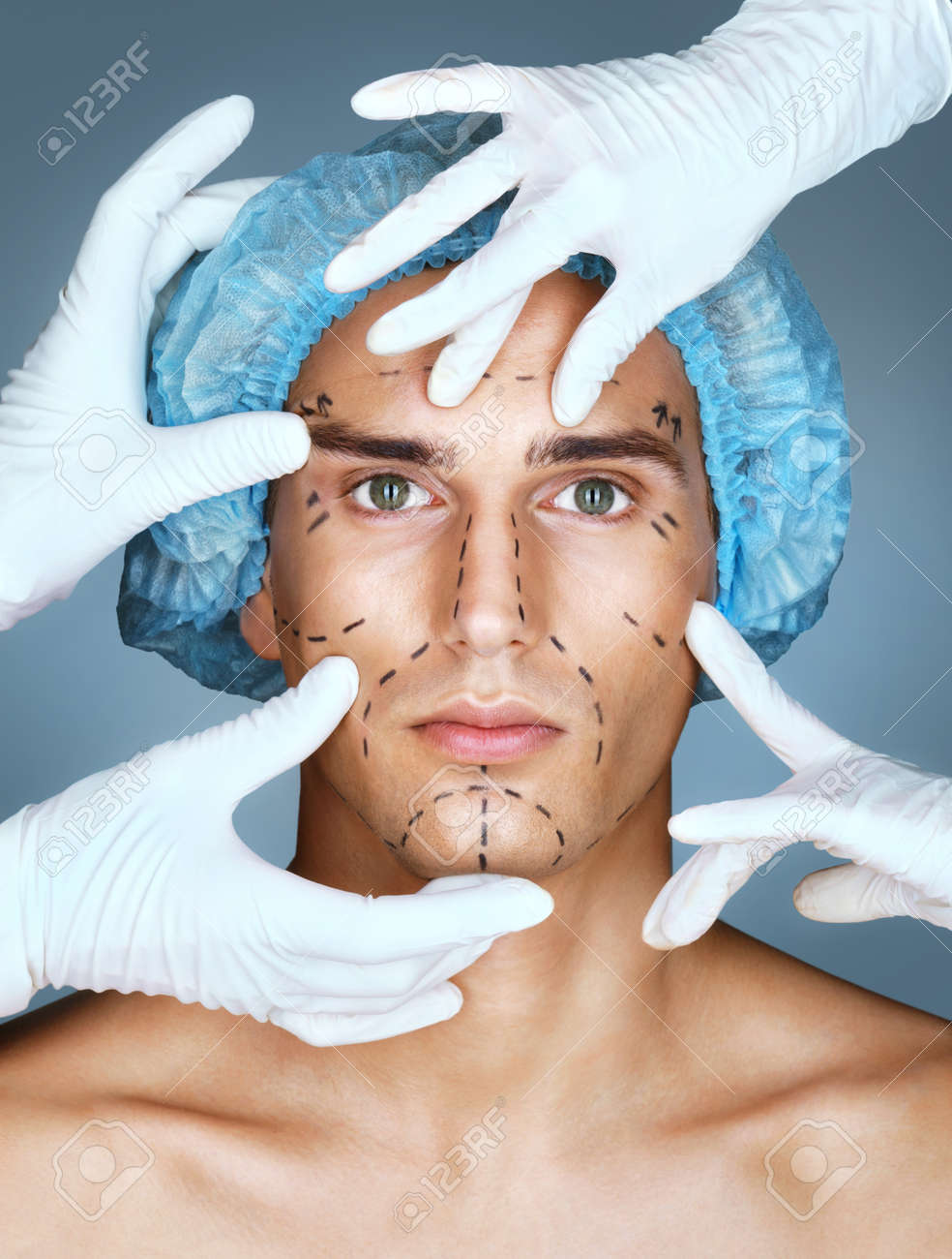 Jonge Man Met Vele Chirurgische Handen Patient Met Potloodstrepen Op De Huid Voor Cosmetische Medische Procedures Chirurgische Mark Lijnen Op De Ogen Neus Wangen En Kaak Schoonheid Gezicht Concept Royalty Vrije Foto Plaatjes