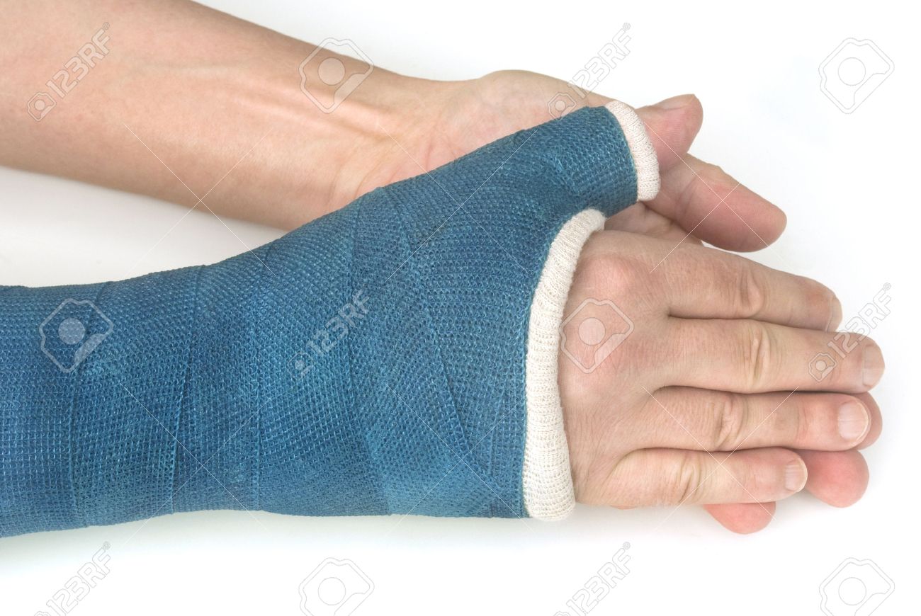 Broken Wrist, Arm With A Blue Fiberglass Cast - My Broken Wrist Stock  Photo, Picture and Royalty Free Image. Image 18857216., image size:1300x870