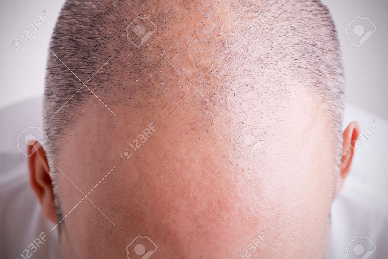 後退ヘアラインで男性の頭の上から見る の写真素材 画像素材 Image 後退ヘアラインで男性の頭の上から見る の写真素材 画像素材 Image