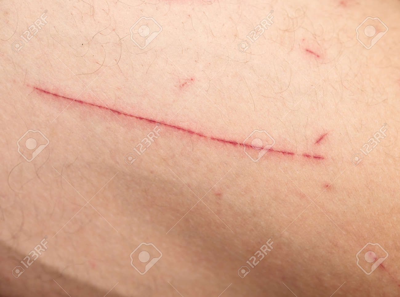 rasguños en la piel rasguños en la piel