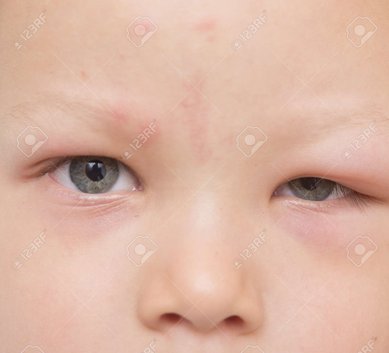 Allergie Apres Les Moustiques Piqueurs Sur Le Visage De Bebe Banque D Images Et Photos Libres De Droits Image