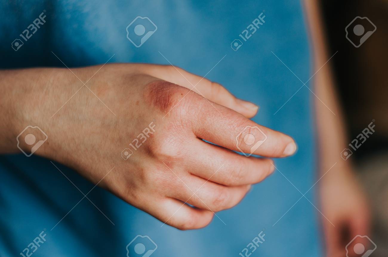 Eczema In Womans Hands Red Allergy Problem Itchy Arms Stock Photo Picture And Royalty Free Image Image