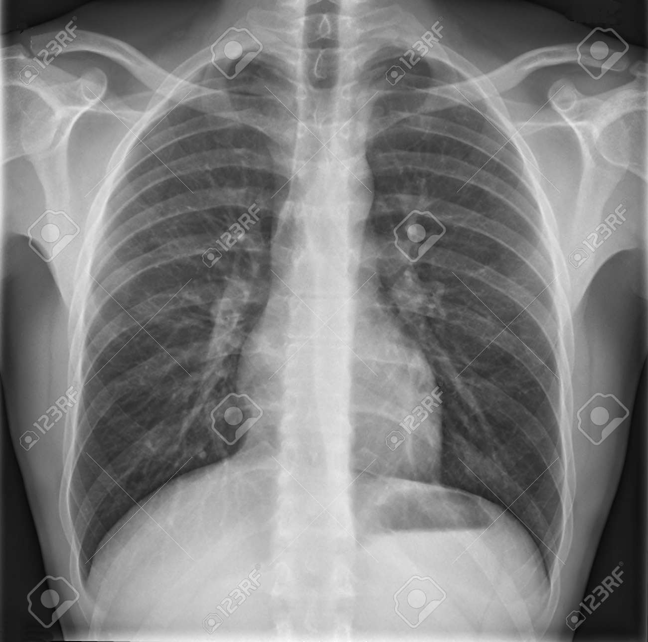 胸部の黒と白の医学のレントゲン写真 の写真素材 画像素材 Image