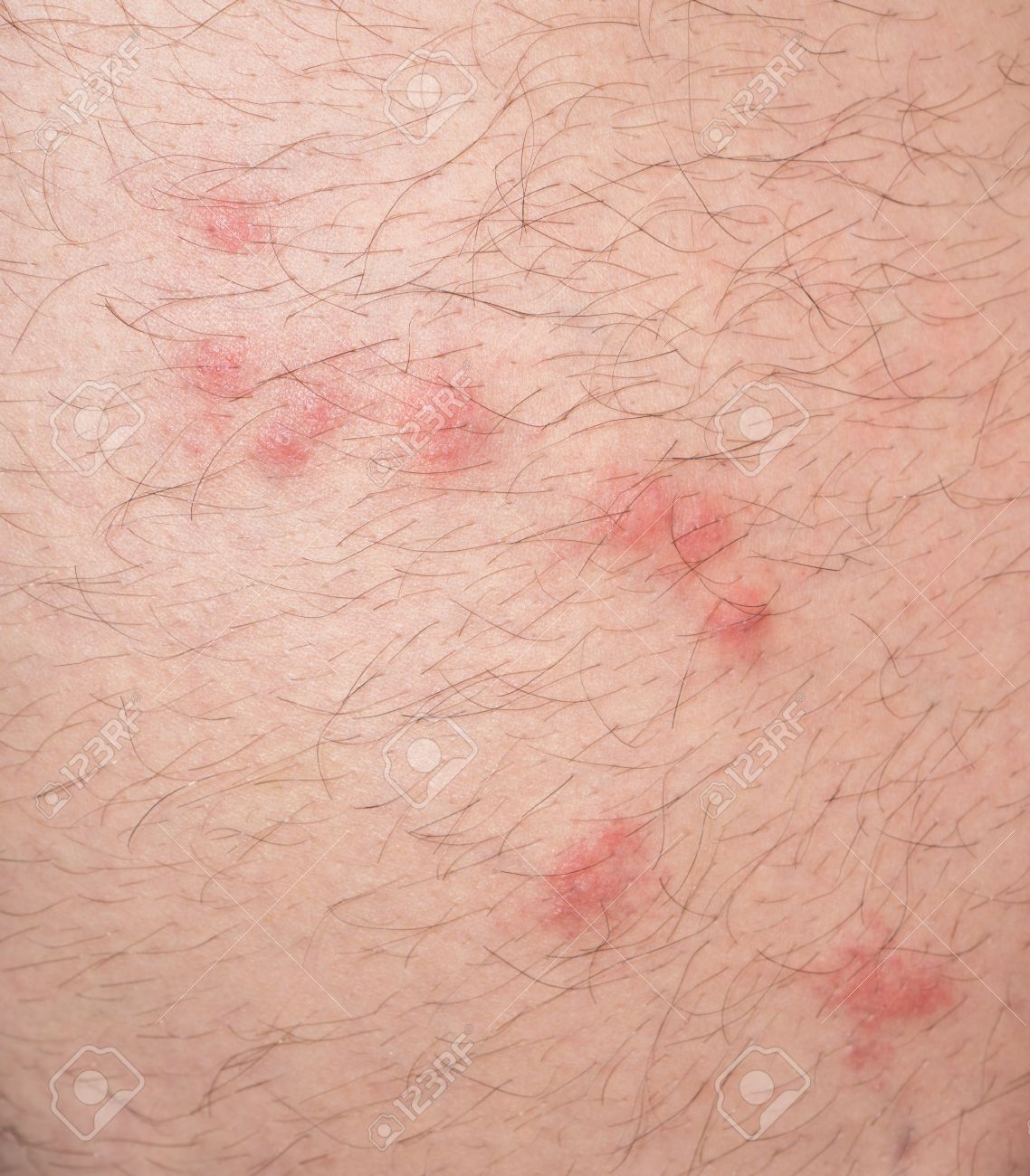 Piqures De Puces Sur L Homme Caucasien Peau Velue Banque D Images Et Photos Libres De Droits Image