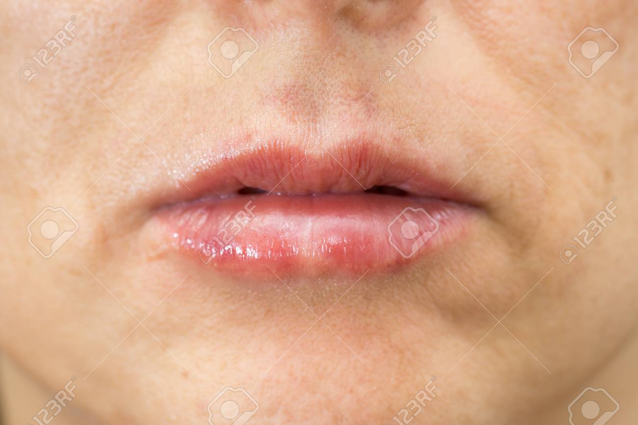 女性の正面治療後唇の腫れの詳細ビュー の写真素材 画像素材 Image