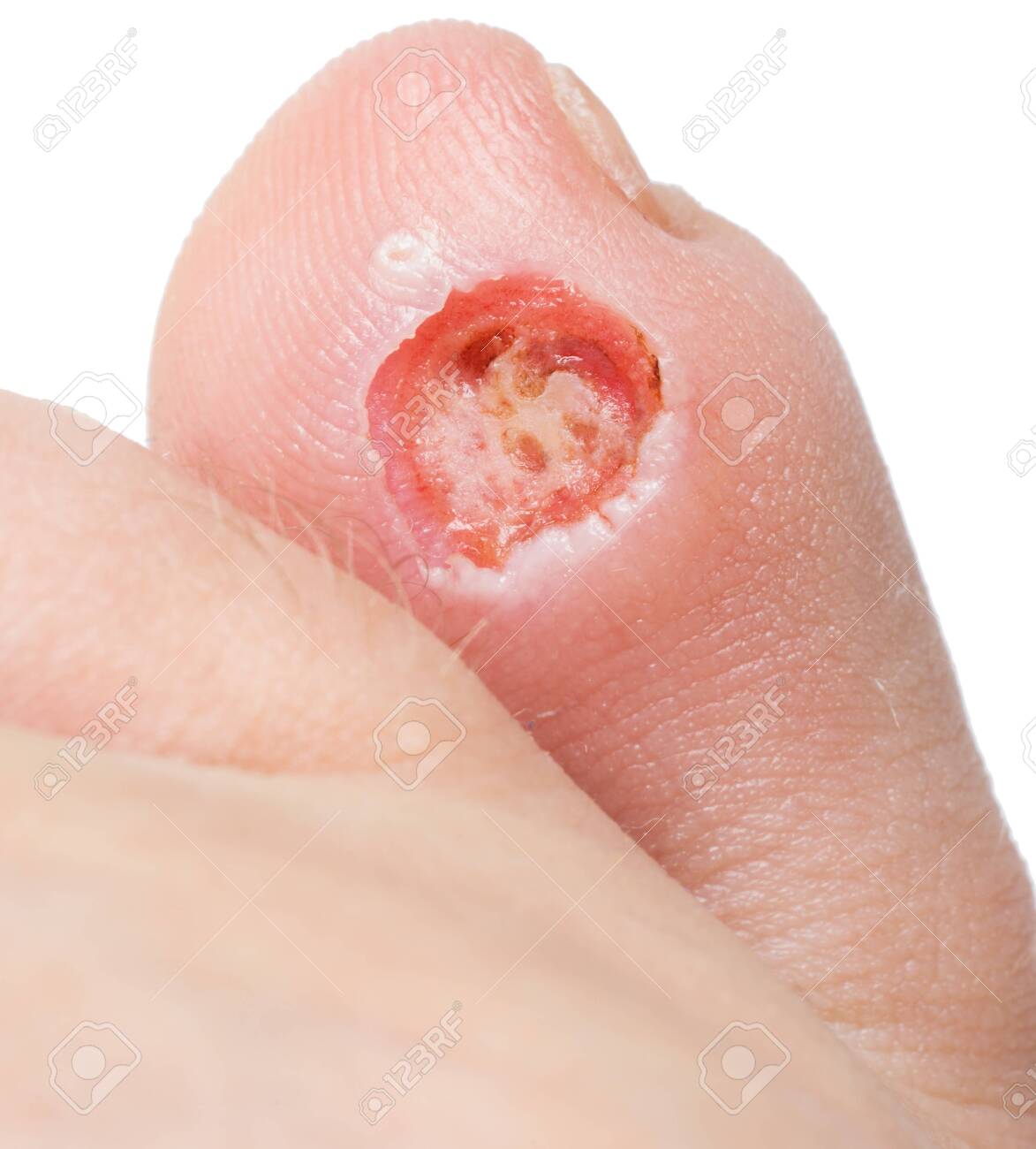 foot corn laser treatment