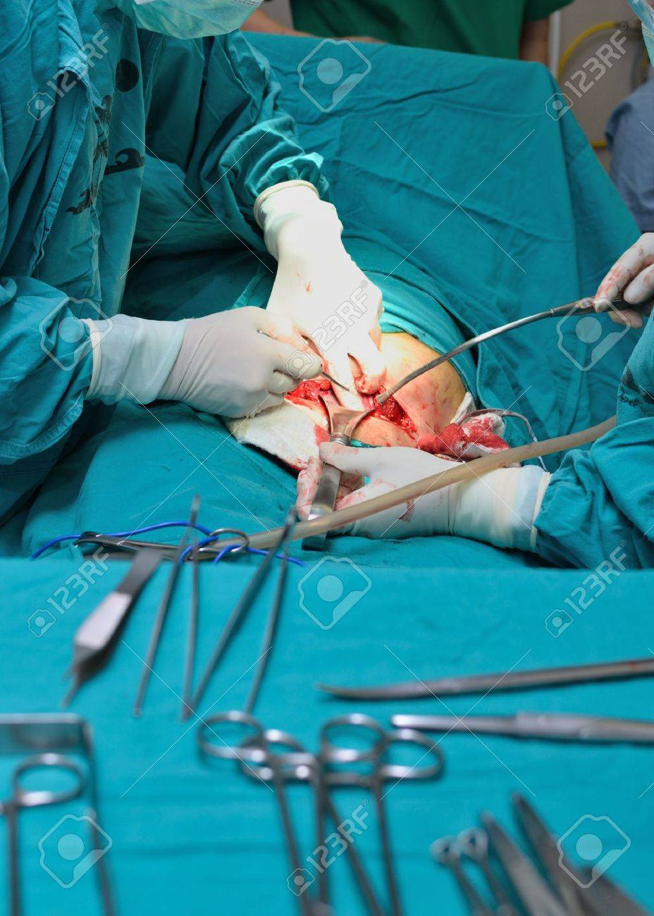 Real operation for cesarean section with new born infant in operating theater. - 14078143 Real operation for cesarean section with new born infant in operating theater. - 14078143