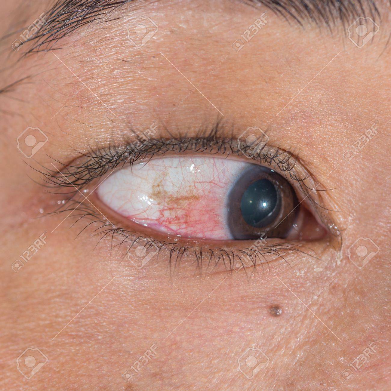 目の検査の中に 上強膜炎のクローズ アップ の写真素材 画像素材 Image