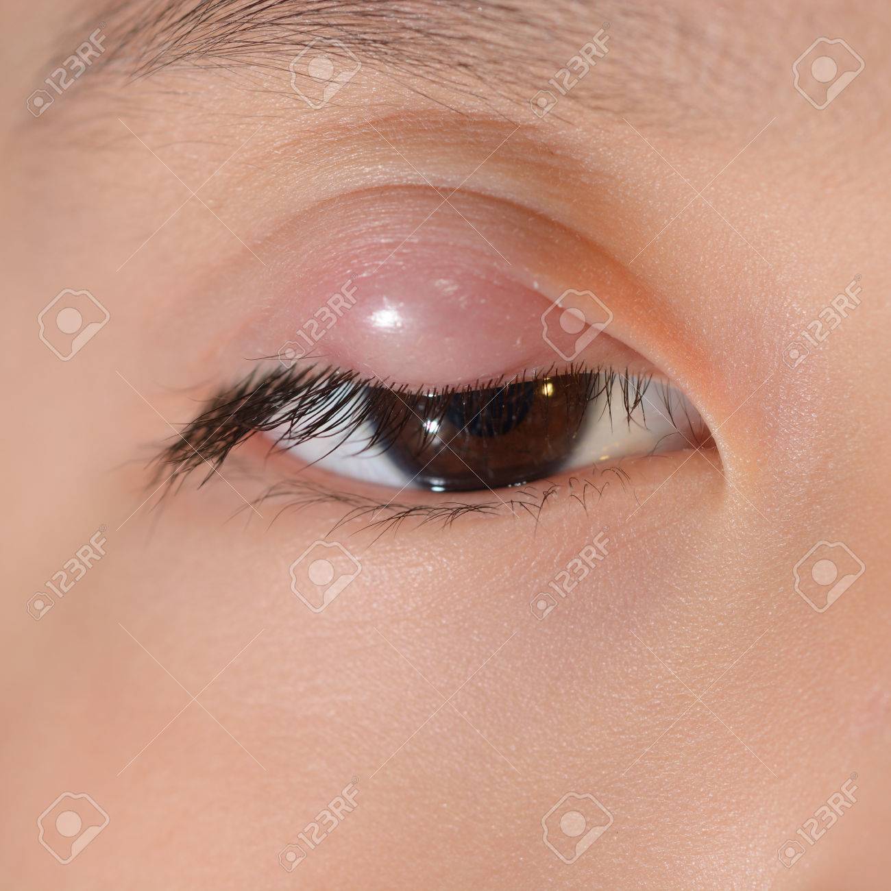 dolor en el parpado superior del ojo derecho