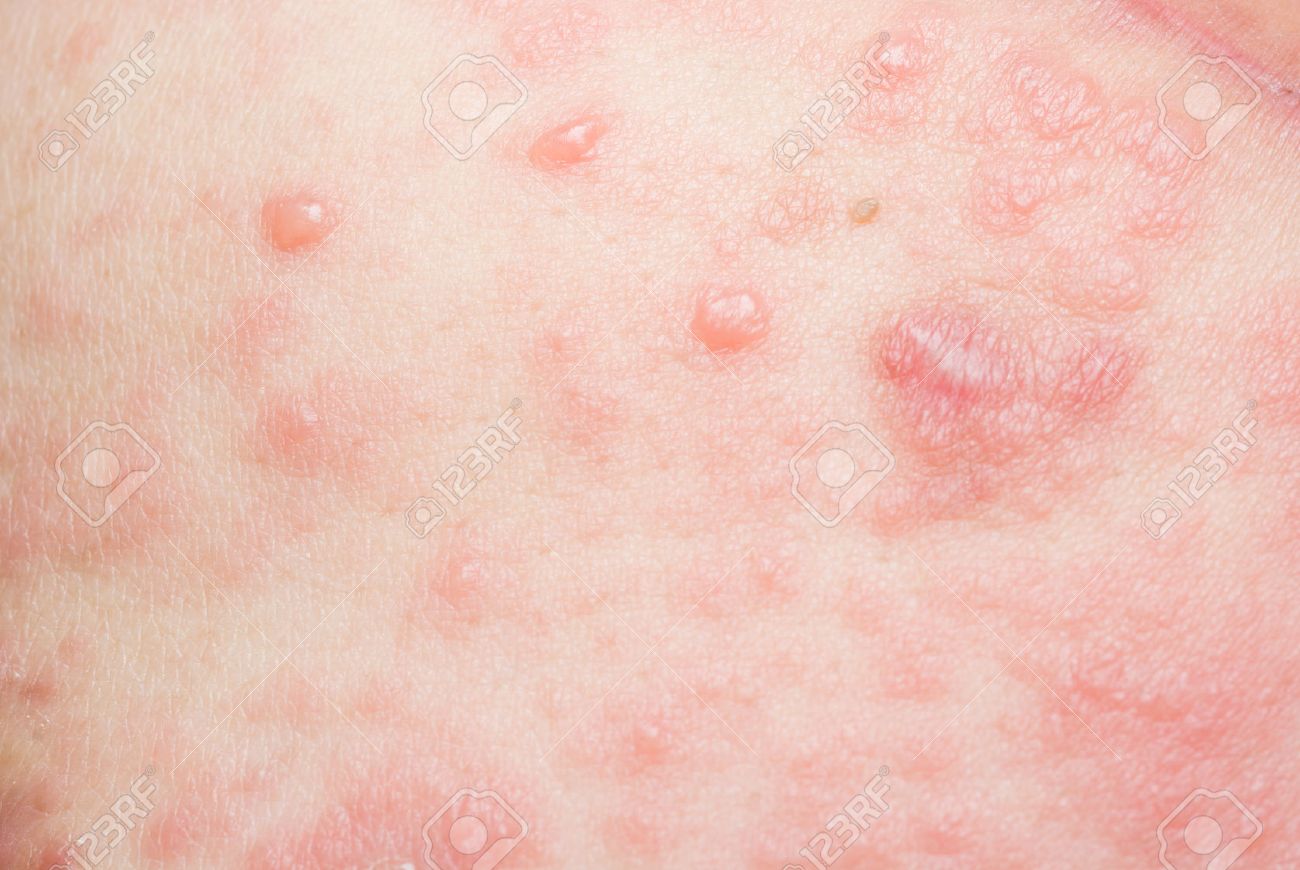allergie cutanée médicamenteuse allergie cutanée médicamenteuse