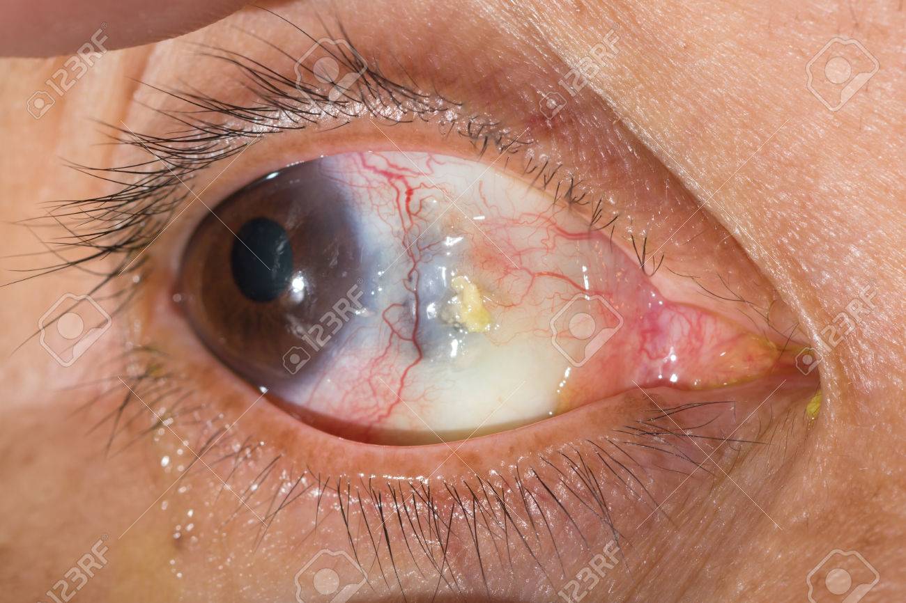 Melting eye best sale