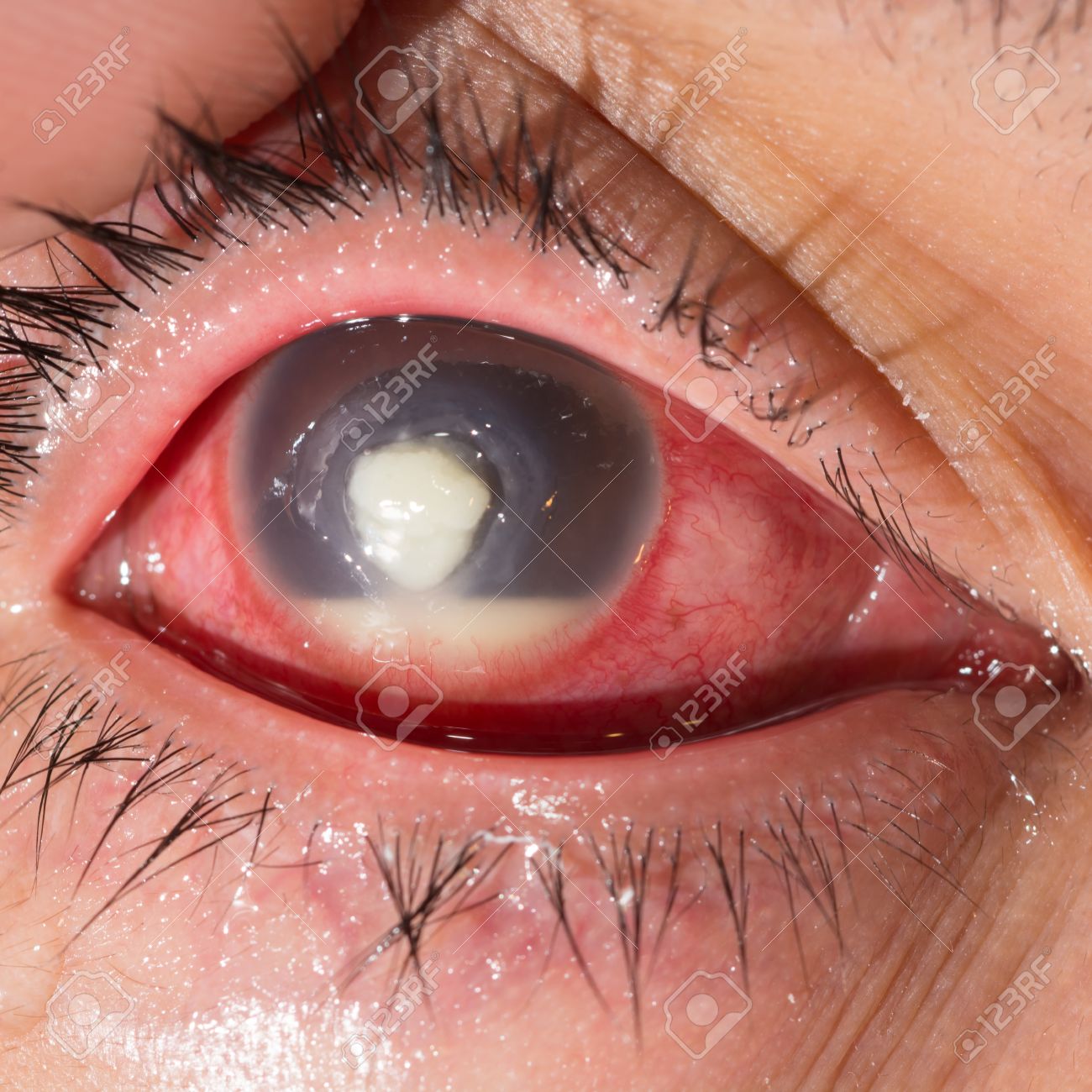 close up of the severe infected corneal ulcer with hypopyon during corneal ulcer