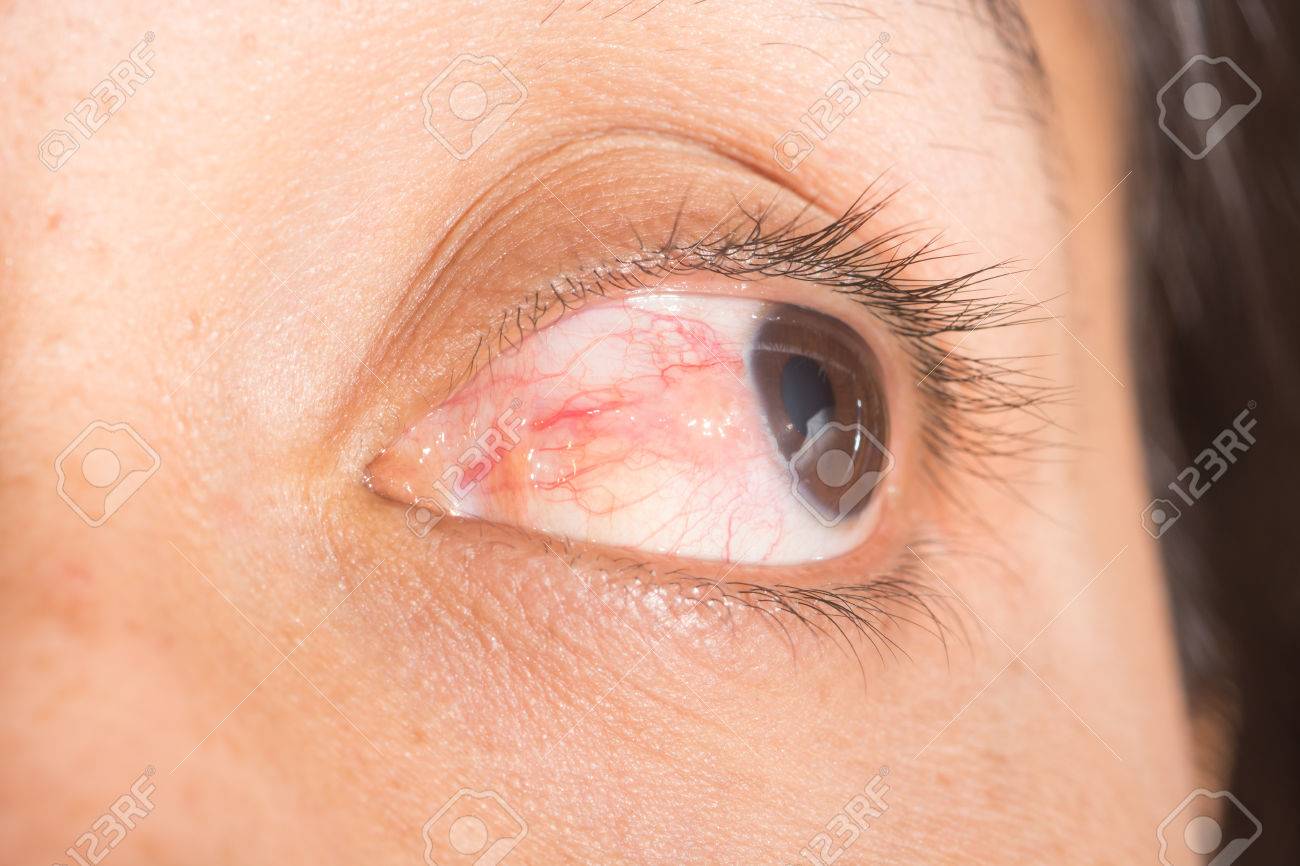 tiene infección ocular