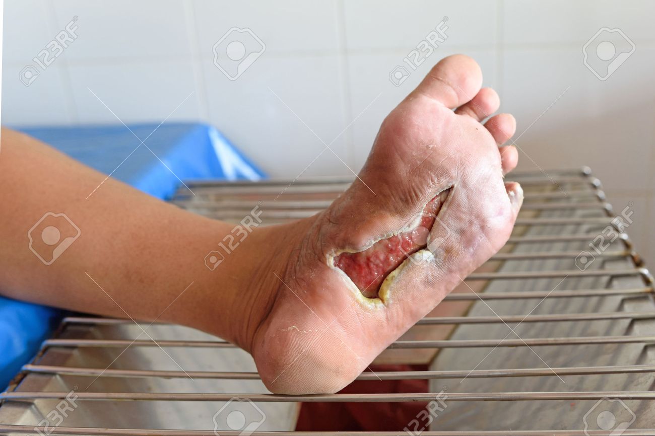blessure pied diabete blessure pied diabete