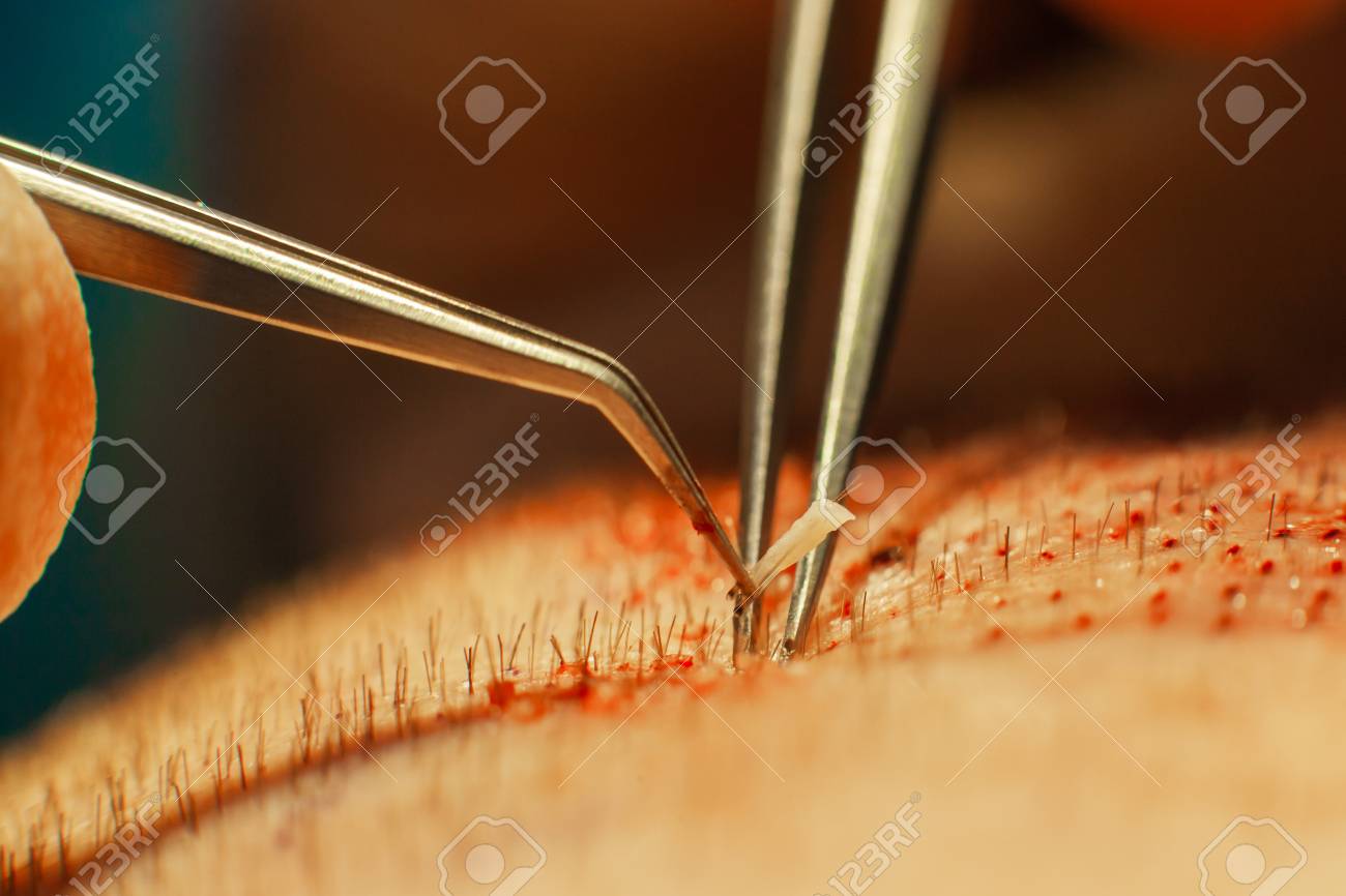 Macrophotography of a hair bulb transplanted into a hairless area. Baldness treatment. Hair transplant. Surgeons in the operating room carry out hair transplant surgery. Surgical technique that moves hair follicles from a part of the head. - 124791688 Macrophotography of a hair bulb transplanted into a hairless area. Baldness treatment. Hair transplant. Surgeons in the operating room carry out hair transplant surgery. Surgical technique that moves hair follicles from a part of the head. - 124791688