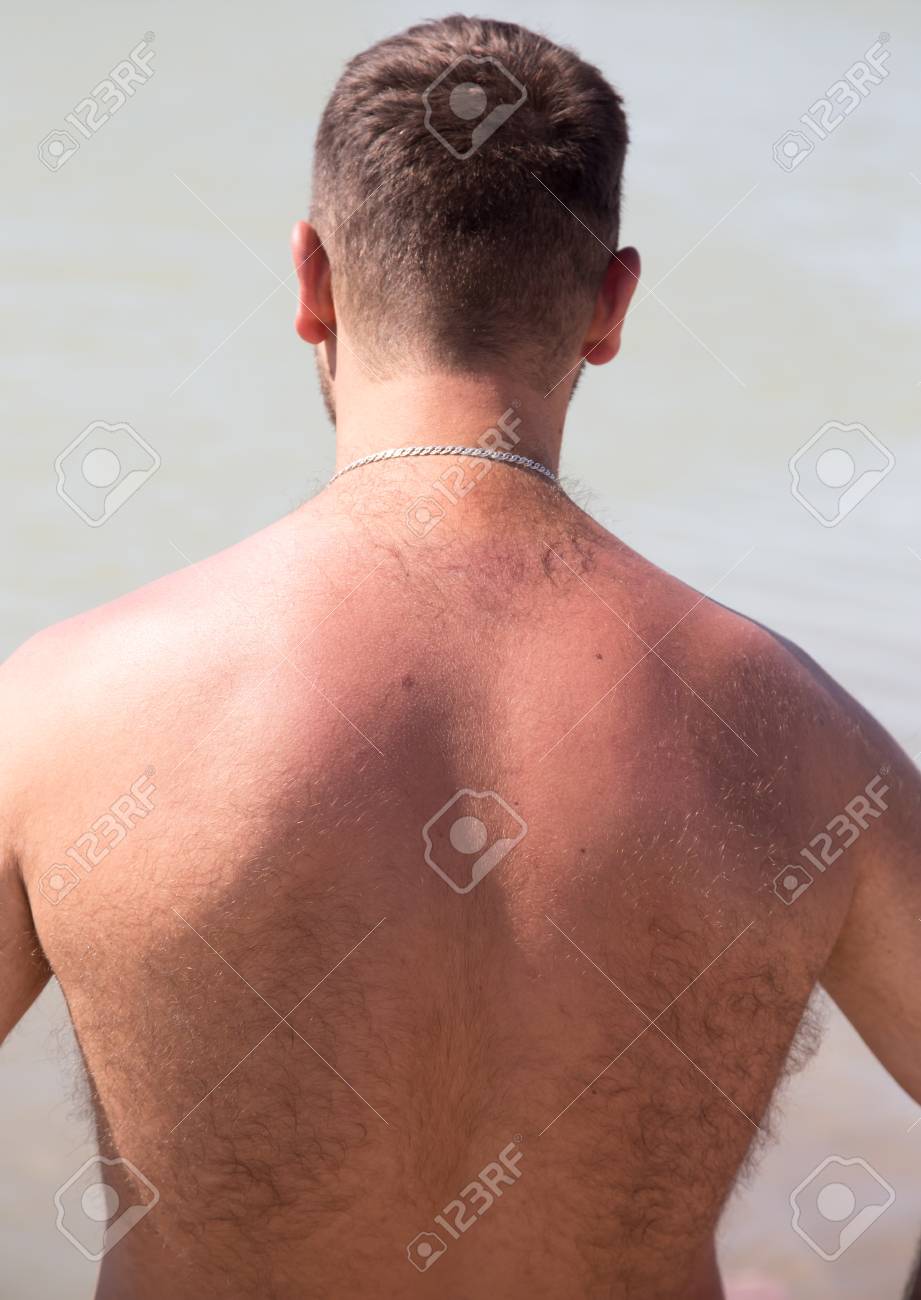 赤の肌は男の背中に日焼け の写真素材 画像素材 Image