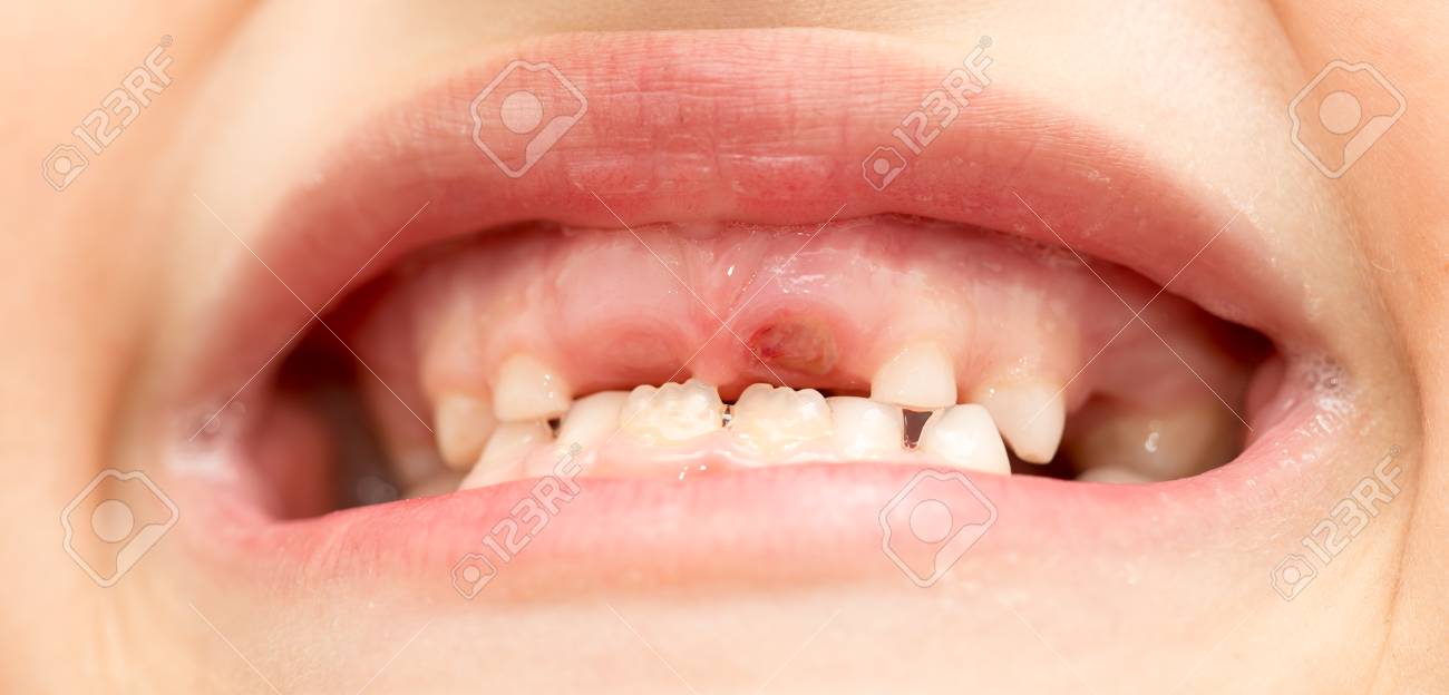 Ohne zÀhne frau Was ist