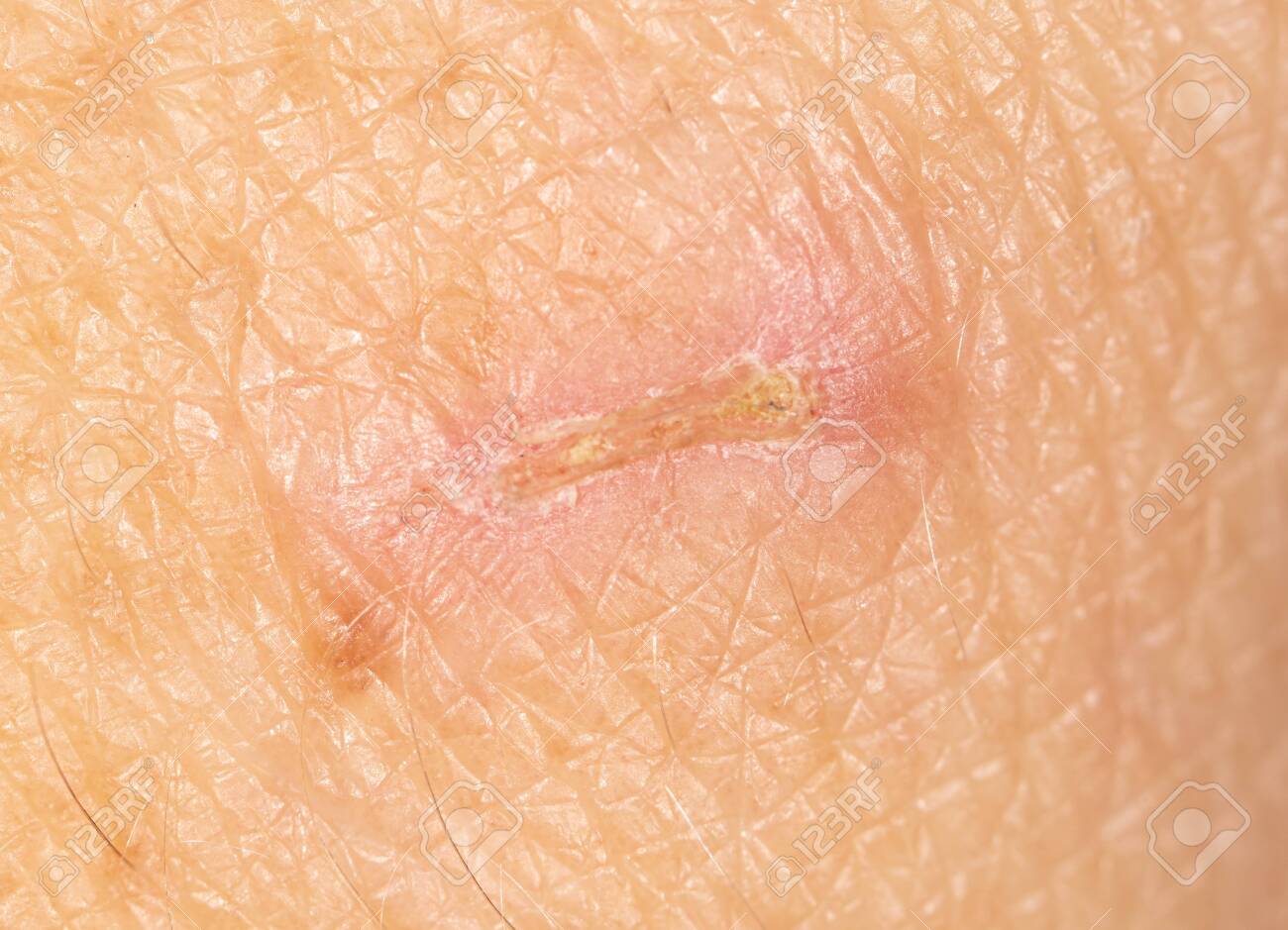 A wound from a knife cut on a person’s skin. Macro - 144422582 A wound from a knife cut on a person’s skin. Macro - 144422582