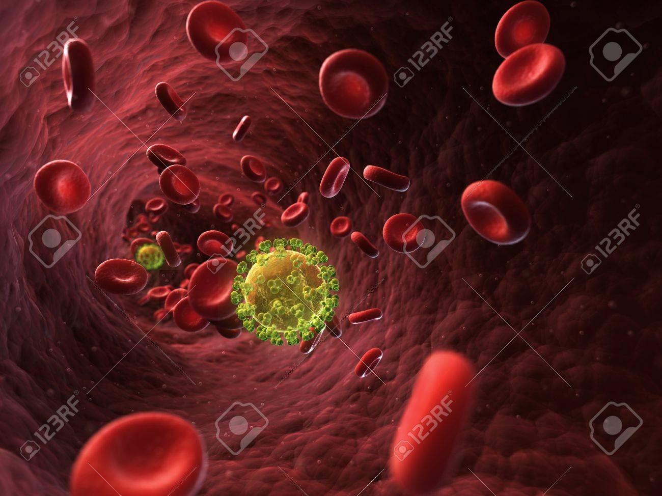 infección con el virus de inmunodeficiencia humana vih