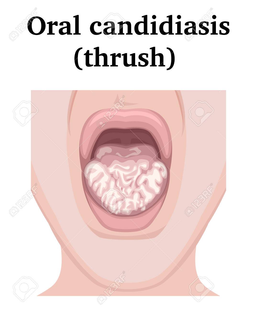 Infeccion bucal por candida albicans