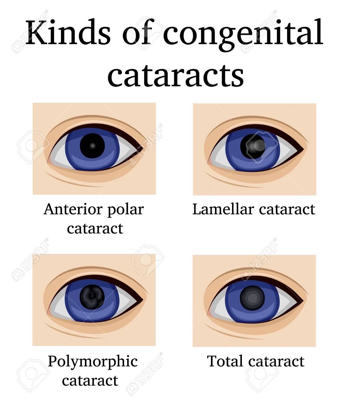 Four kinds of congenital cataracts, such as anterior polar, lamellar, polymorphic and total - 90908814 Four kinds of congenital cataracts, such as anterior polar, lamellar, polymorphic and total - 90908814
