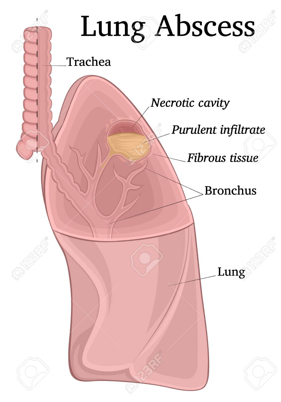 Illustration of a sectioned lungs depicting a purulent-necrotic cavity - an abscess - 125919655 Illustration of a sectioned lungs depicting a purulent-necrotic cavity - an abscess - 125919655