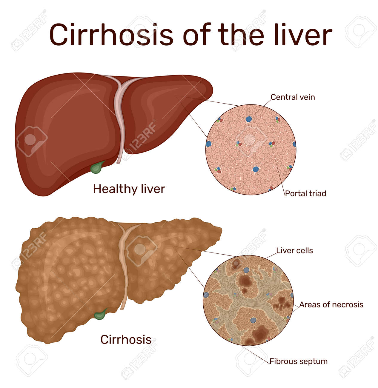 Illustration of chronic liver disease cirrhosis. Depicted is a healthy and diseased liver - 156340168 Illustration of chronic liver disease cirrhosis. Depicted is a healthy and diseased liver - 156340168