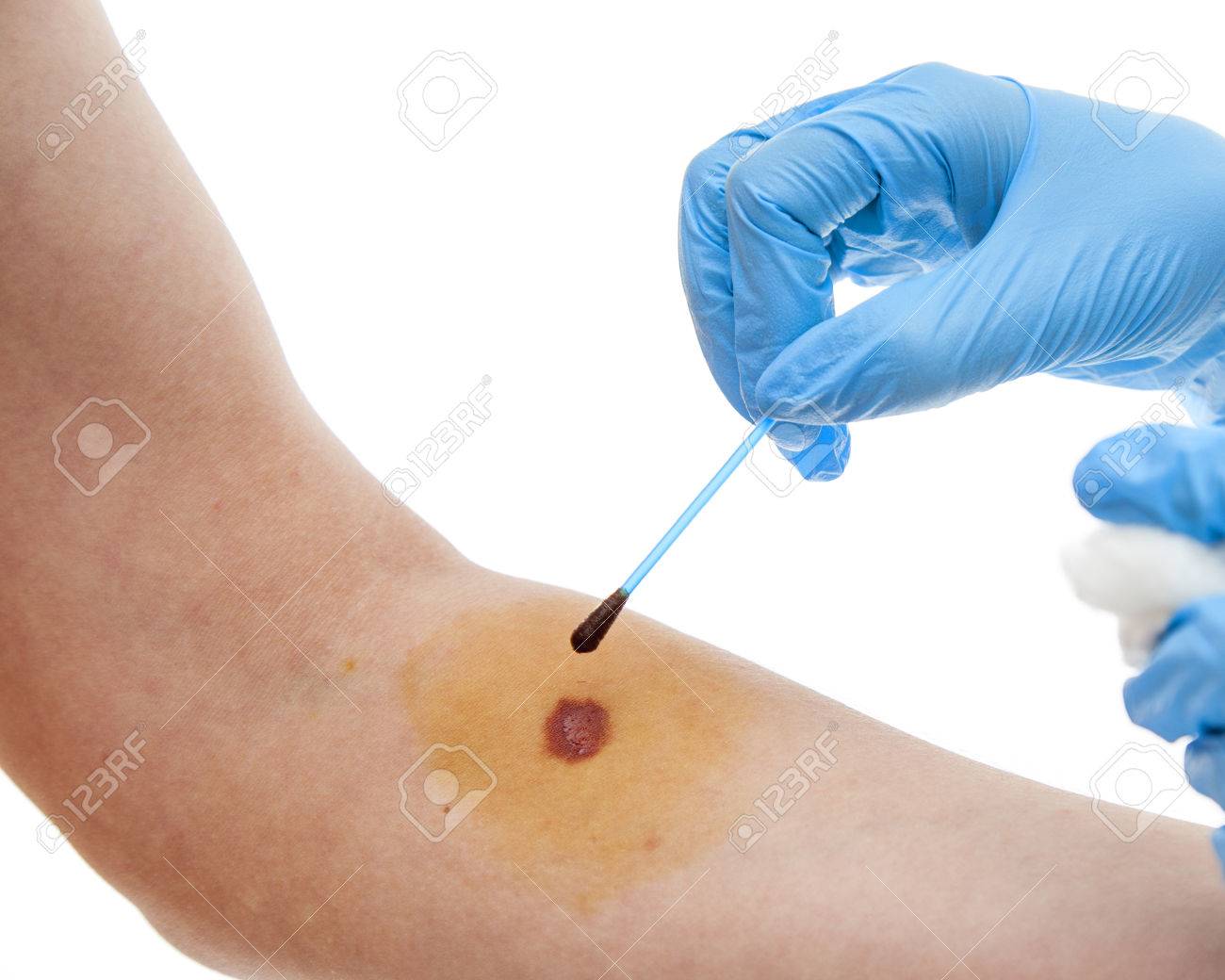 Nurse Applying Arm With Iodine Solution Stock Photo Picture And Royalty Free Image Image 41904764