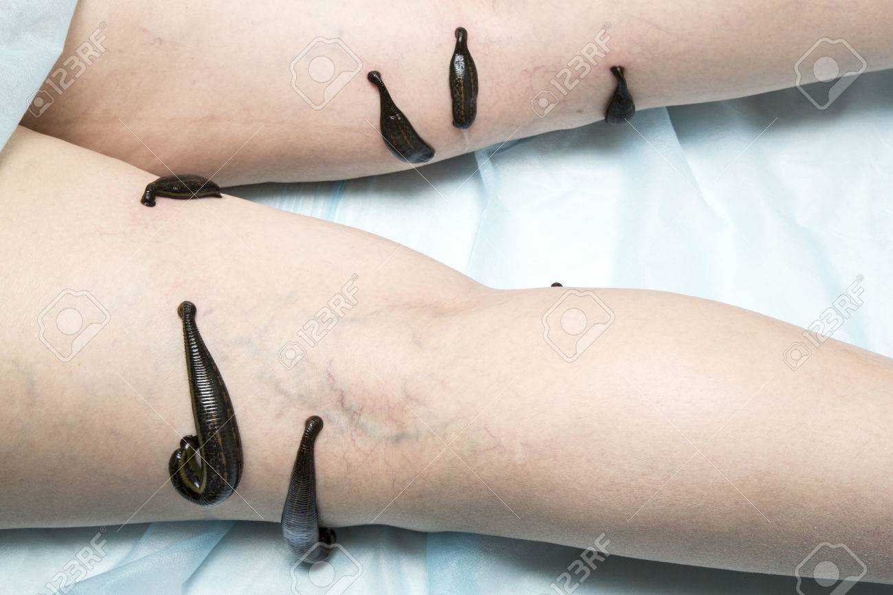 大人の女性の下肢の蛭血栓性静脈炎の治療 の写真素材 画像素材 Image 大人の女性の下肢の蛭血栓性静脈炎の治療 の写真素材 画像素材 Image